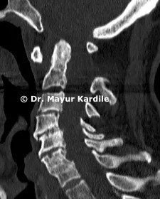 Atlantoaxial Instability — upper cervical spine treatment at Pune Spine Institute