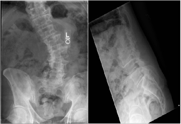 Flatback Deformity — Adult Degenerative Scoliosis with Flat Back Syndrome treatment