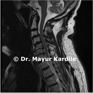 Cervical Spondylotic Myelopathy — treatment at Pune Spine Institute