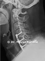 ACDF — Anterior Cervical Discectomy and Fusion surgery at Pune Spine Institute