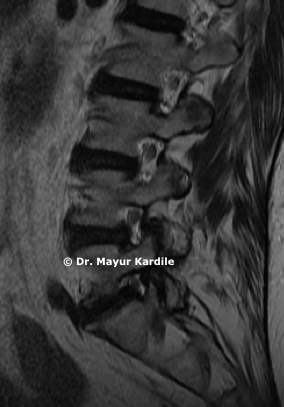 OLIF — Oblique Lumbar Interbody Fusion minimally invasive spine surgery Pune