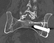 Minimally Invasive SI Joint Fusion — sacroiliac joint surgery at Pune Spine Institute