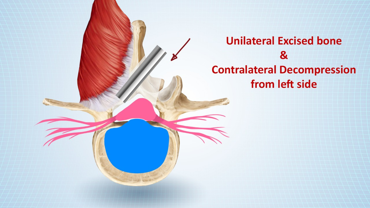 Minimally Invasive Lumbar Decompression — keyhole spine surgery Pune Spine Institute